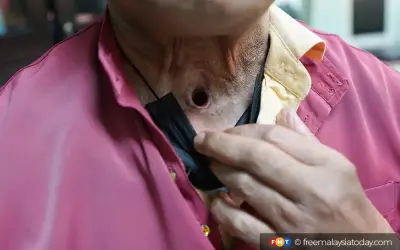 Bersara dan hilang suara akibat kanser laring tanpa pernah merokok